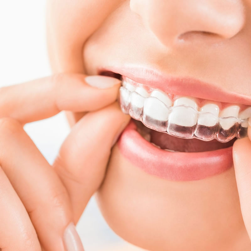 Invisalign – Invisible Braces - Haymarket Dental Care, Haymarket  Gainesville Warrenton VA Dentists, Find Top Dentists in Haymarket  Gainesville VA, Prince William County Dentist Directory